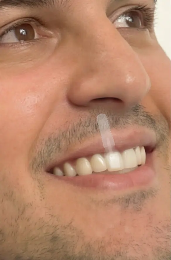 Manhood_implante_1 Implantes y sonrisa