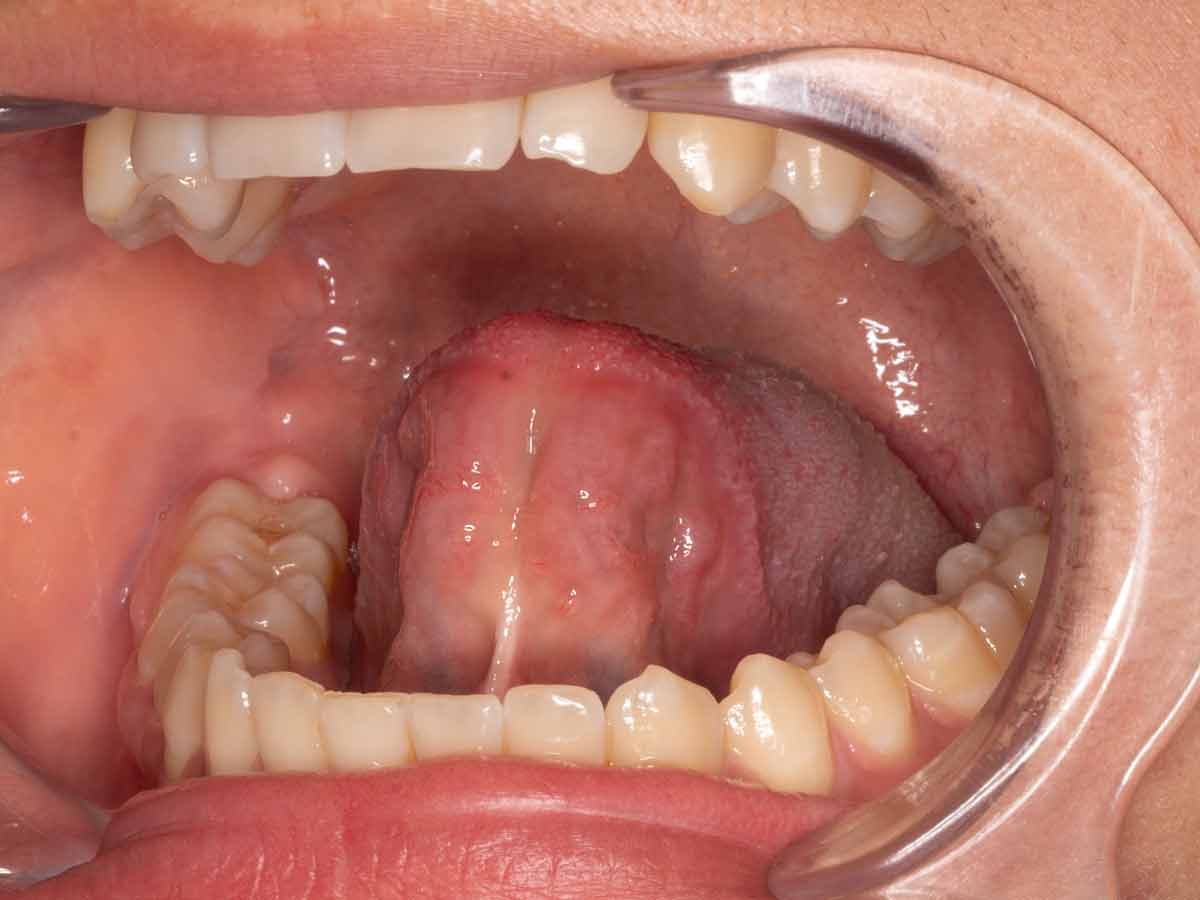 Resección frenillo lengua