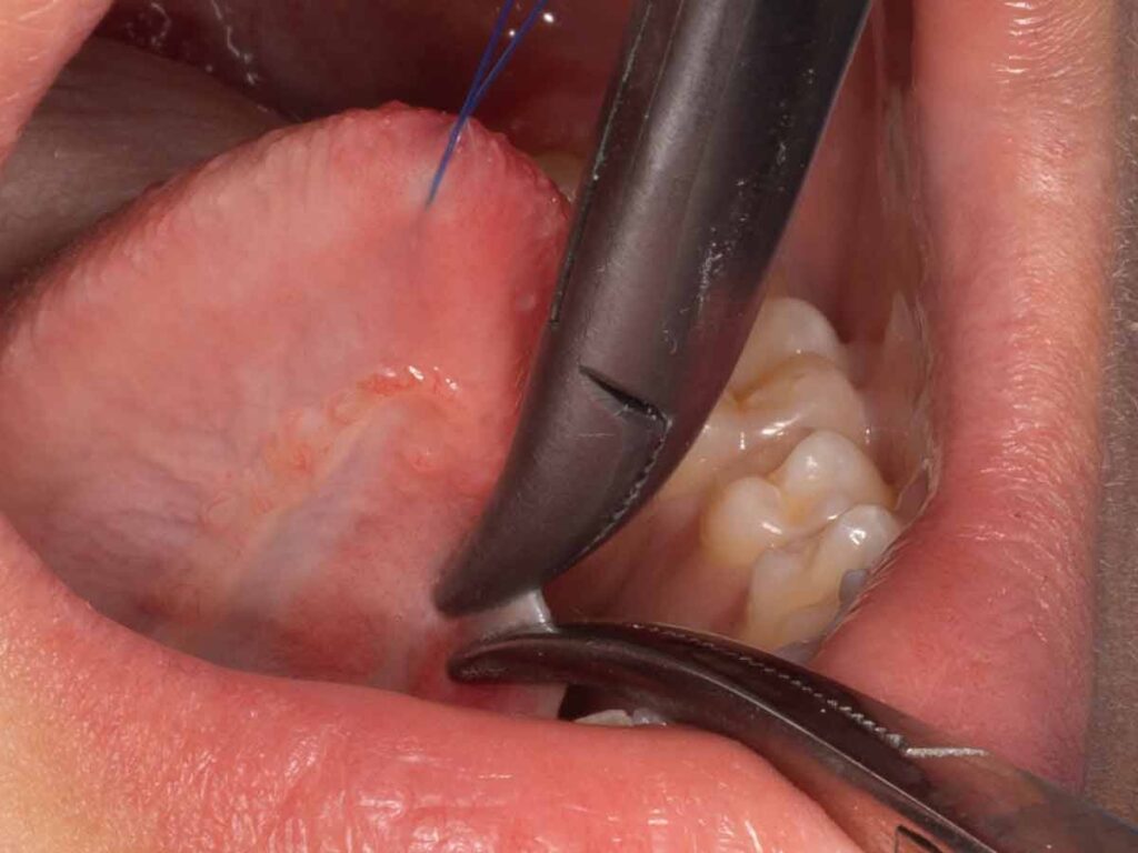 Inicio de intervención de resección frenillo lengua