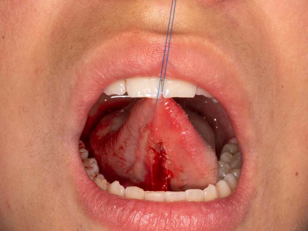 Frenillo lingual removido