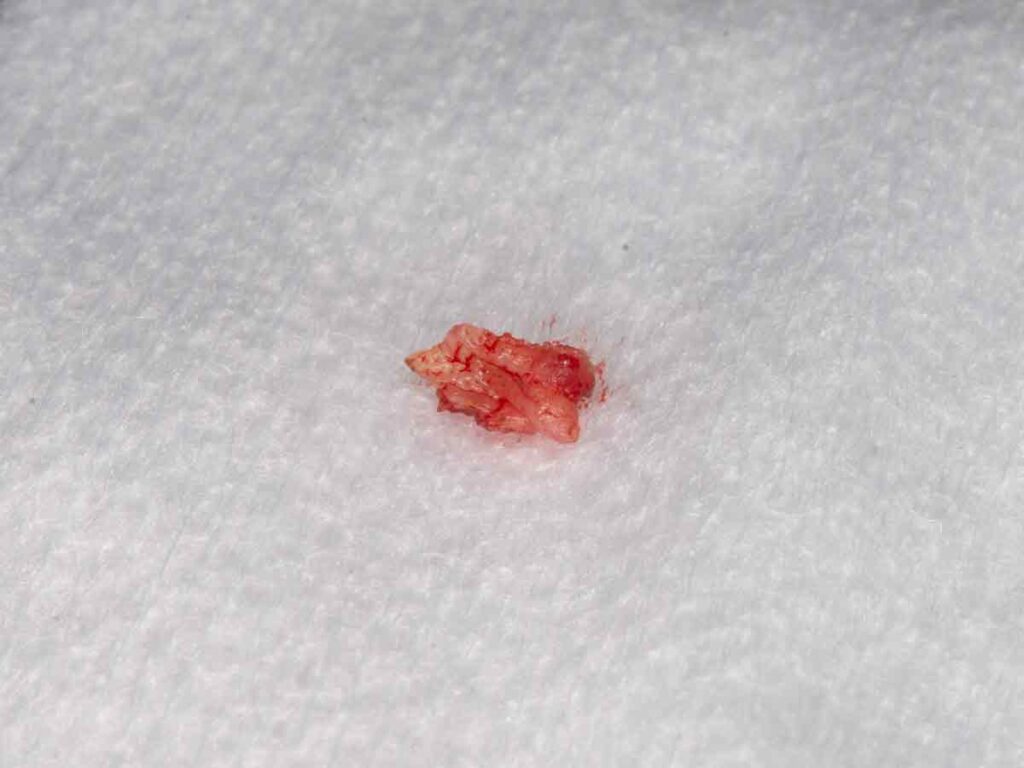 Resección frenillo lengua, pieza operatoria