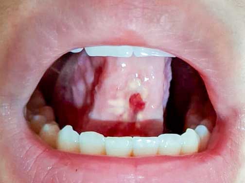 Resección frenillo postoperatorio 18 horas