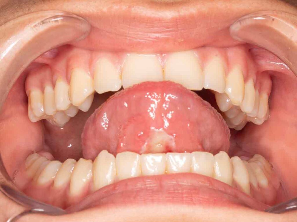 Postoperatorio 7 días de resección frenillo lengua sin dolor y recuperación 100% motilidad lingual