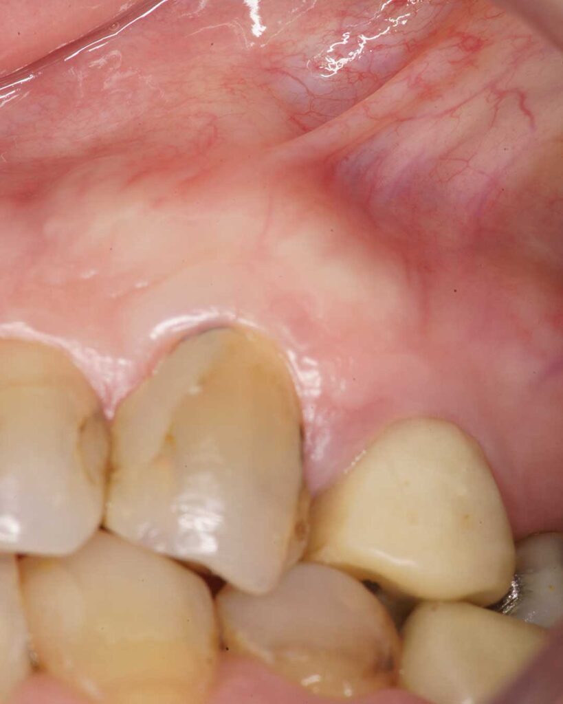 Mini implante ortodoncia preoperatorio