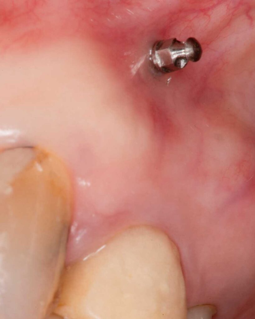 Mini implante ortodoncia