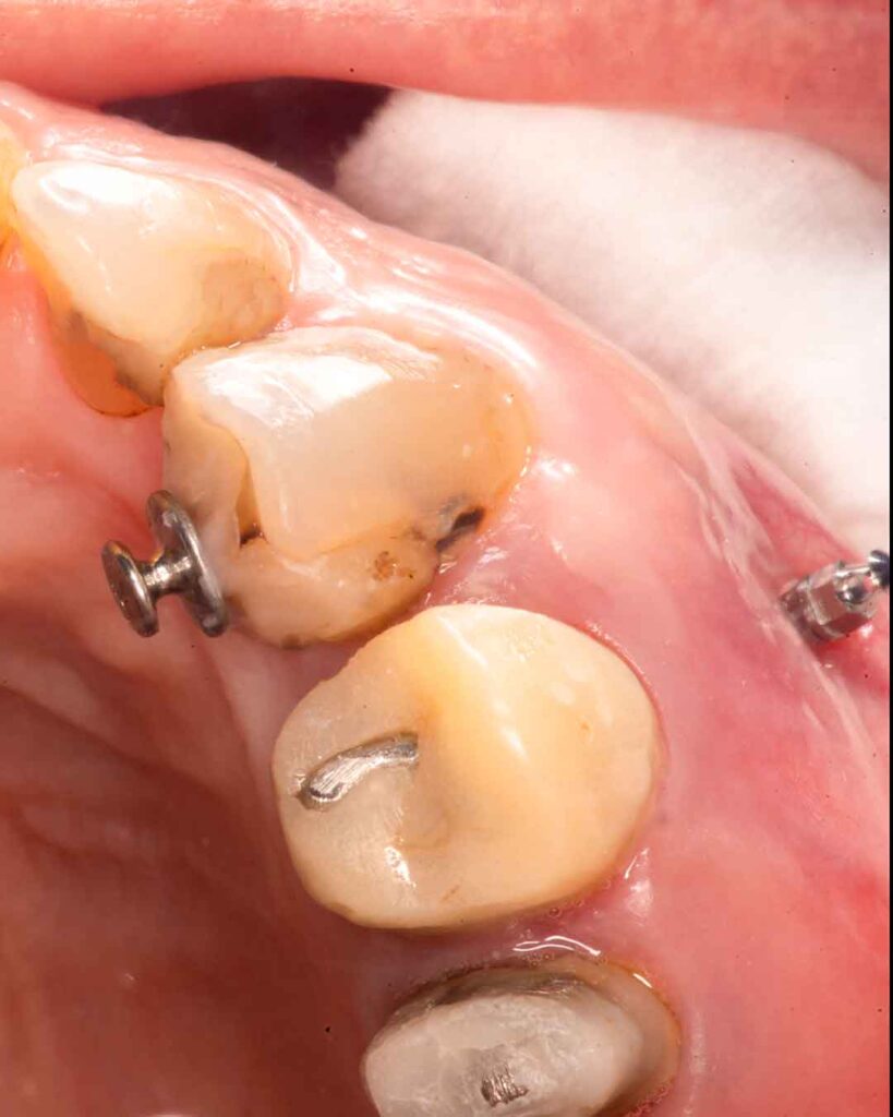 Mini implante ortodoncia y botón