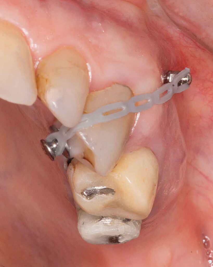 Mini implante y botón conectados