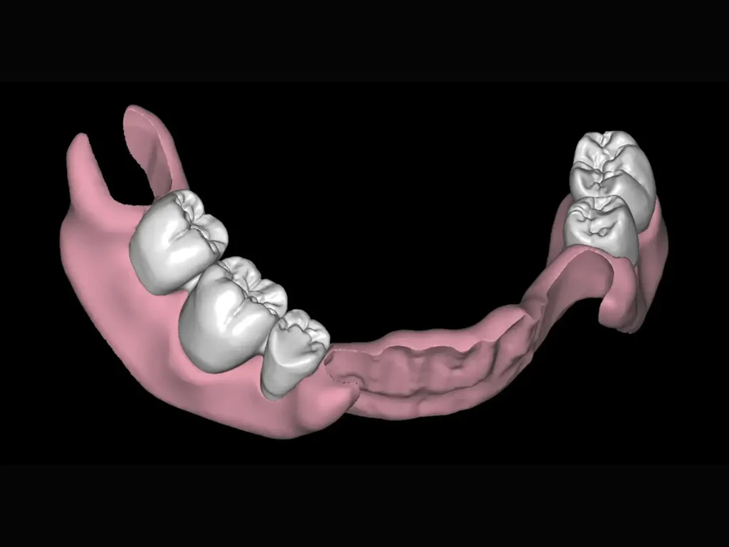 Prótesis flexible digital