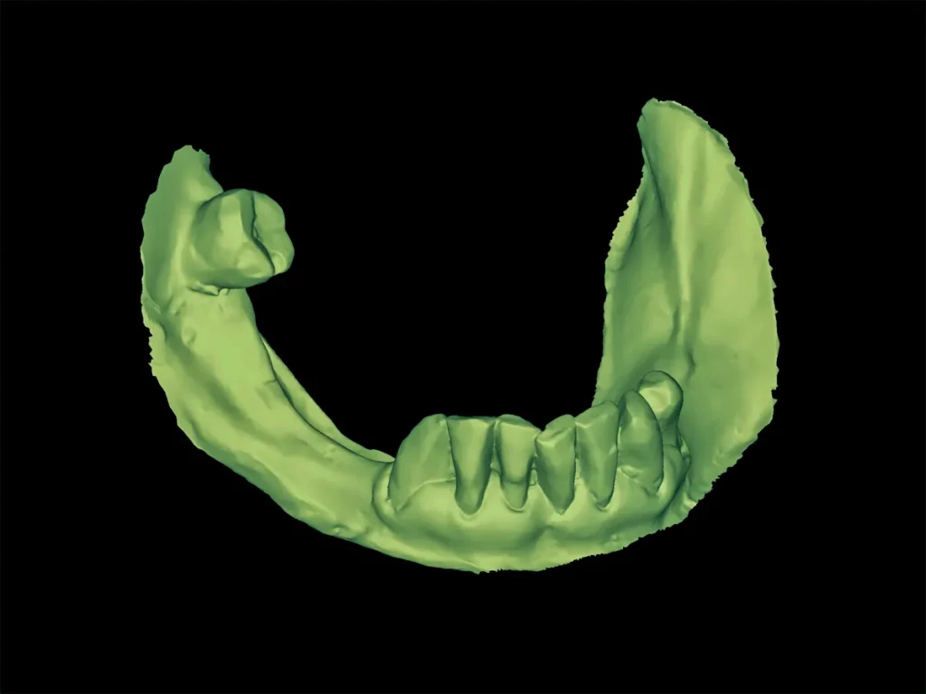 Prótesis flexible digital modelo inicial