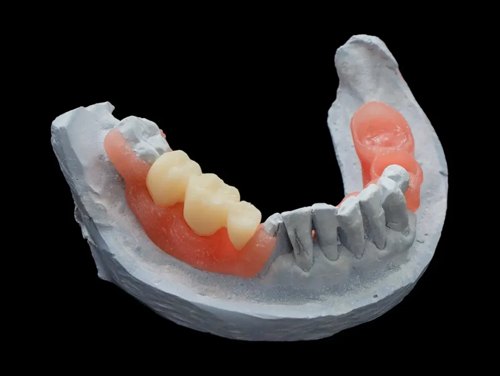 Prótesis flexible digital sobre modelo