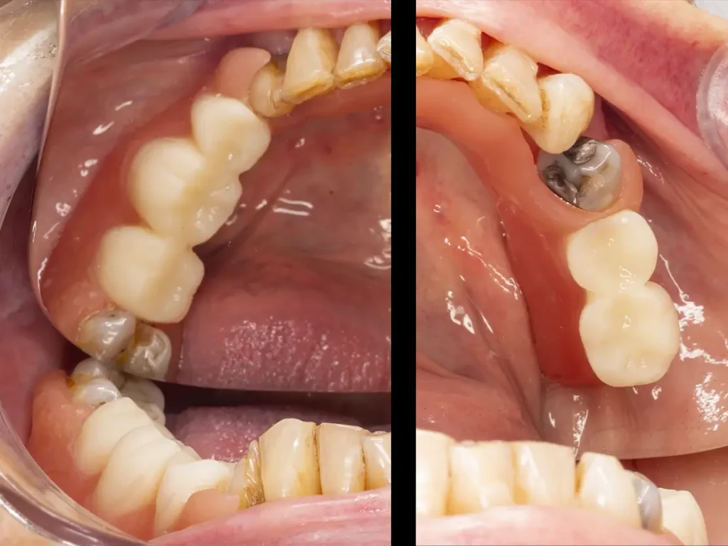 Prótesis flexible digital en boca