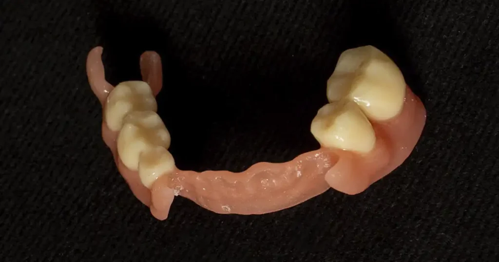 Prótesis flexible digital terminada