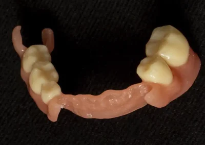 Prótesis removible dental, flexible digital