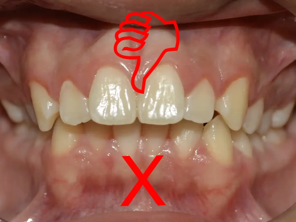 Alteracion en desarrollo de maxilares