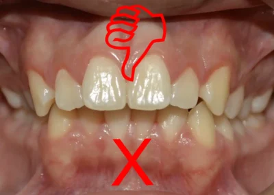 Alteracion en desarrollo de maxilares
