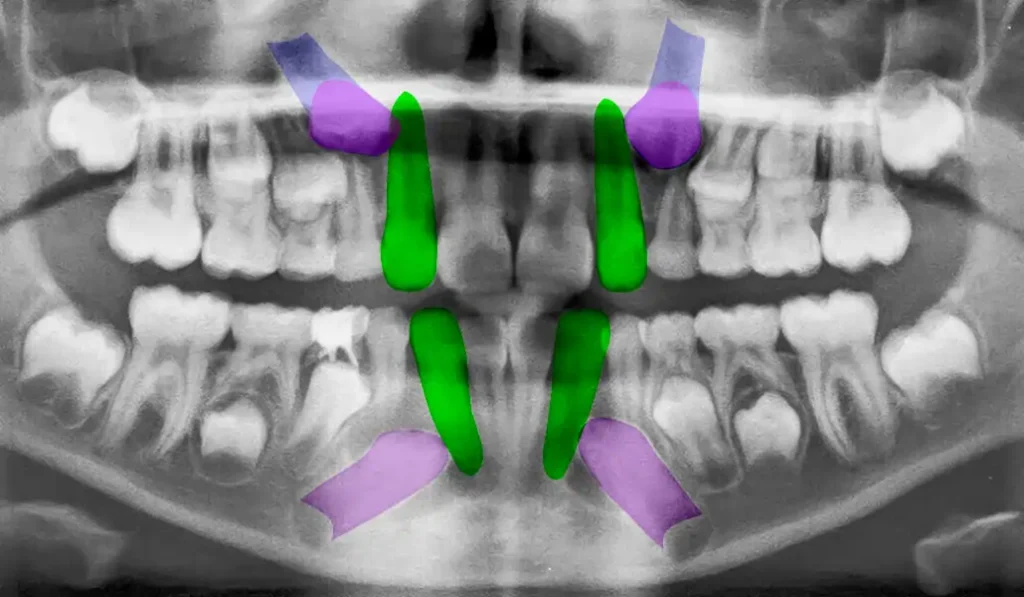 Cuatro Caninos retenidos radiografía