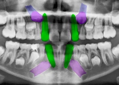 Radiografía de canino retenido en paciente adolescente