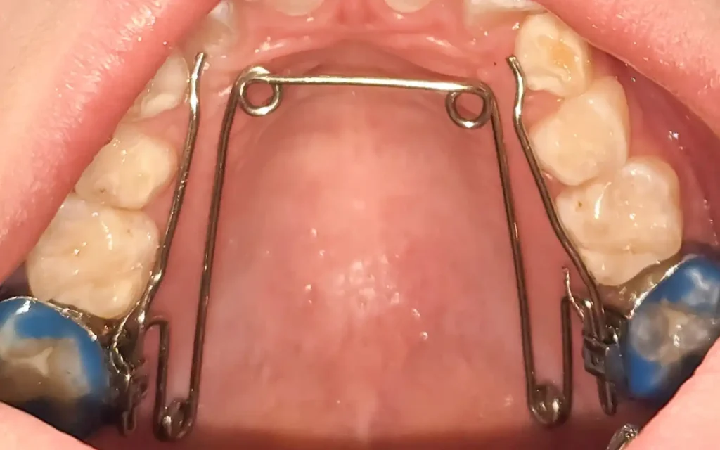 Ortopedia temprana con quadri-helix