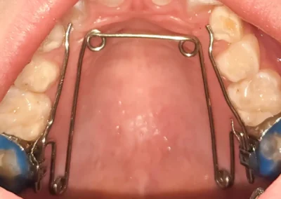 Expansión con quad-helix para crear espacio en caso de canino retenido