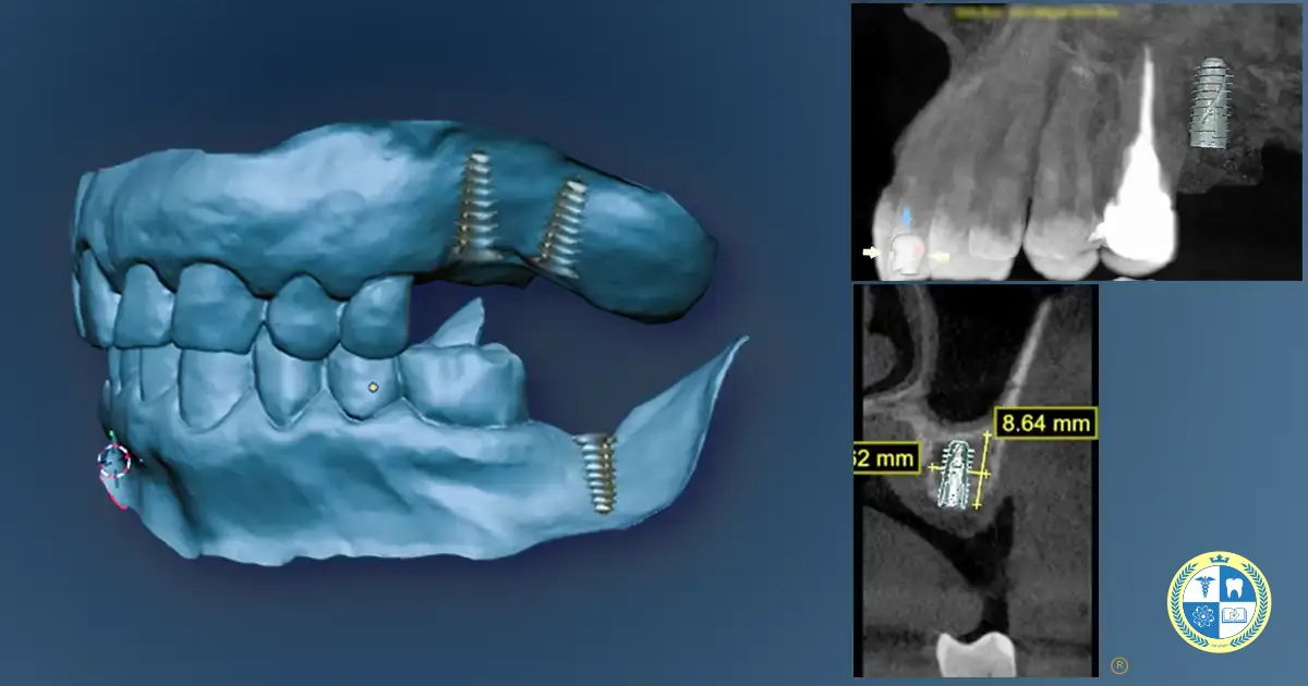 Implante Dental planificación 3D Implante dental unitario planificado en Clínica Manhood Puerto Varas