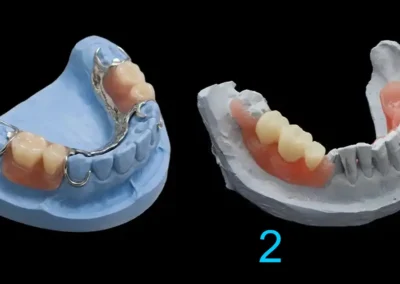 Prótesis dental parcial: 1 metálica y 2 flexible