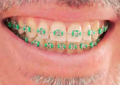 Ortodoncia en Puerto Varas paciente feliz