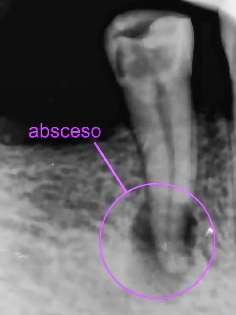 endodoncia radiografia periapical lesion apical puerto varas