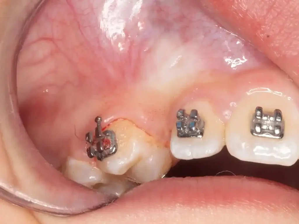 Canino retenido pre operatorio