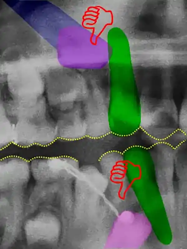 Canino retenido radiografía
