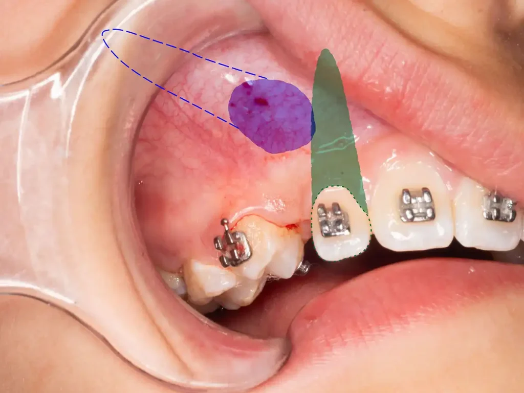 Canino retenido esquema clínico