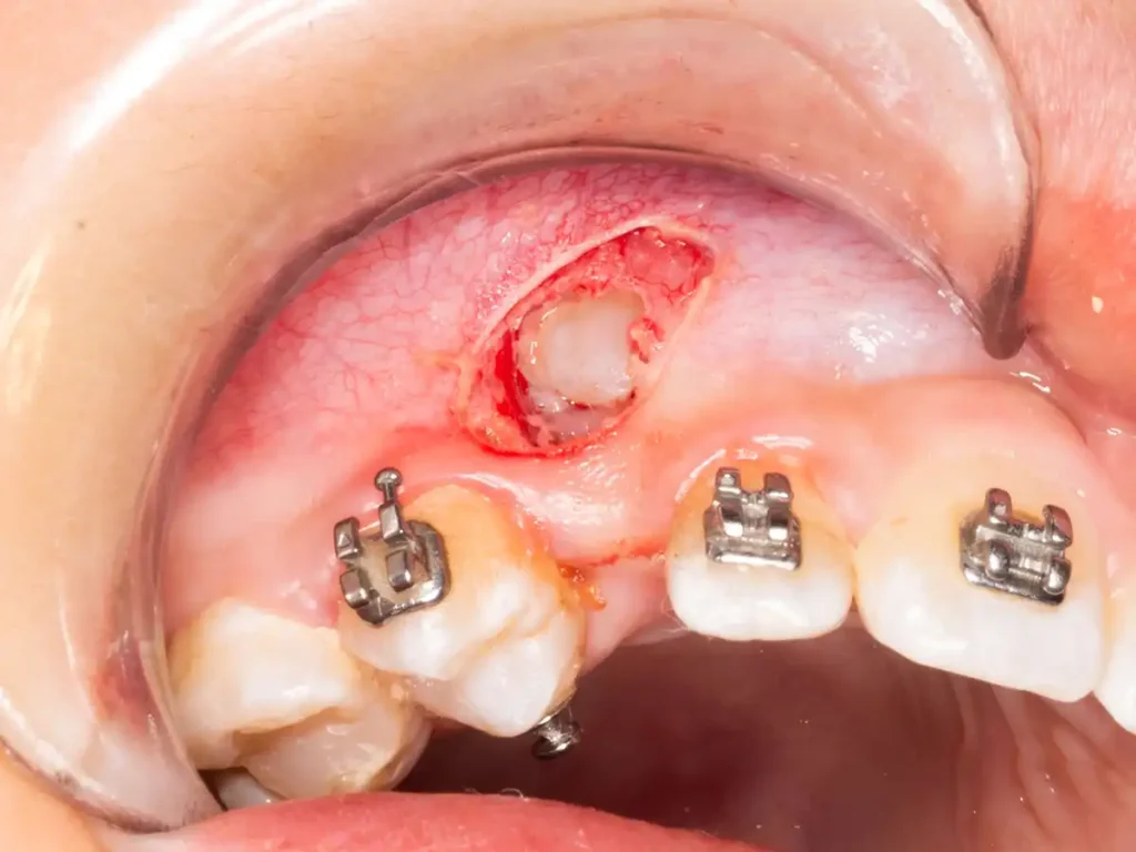 Canino retenido antes de exposición quirúrgica