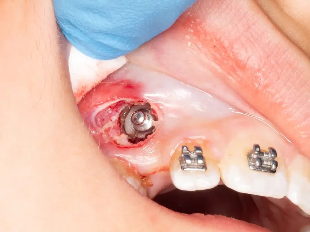 Canino retenido botón adherido al diente