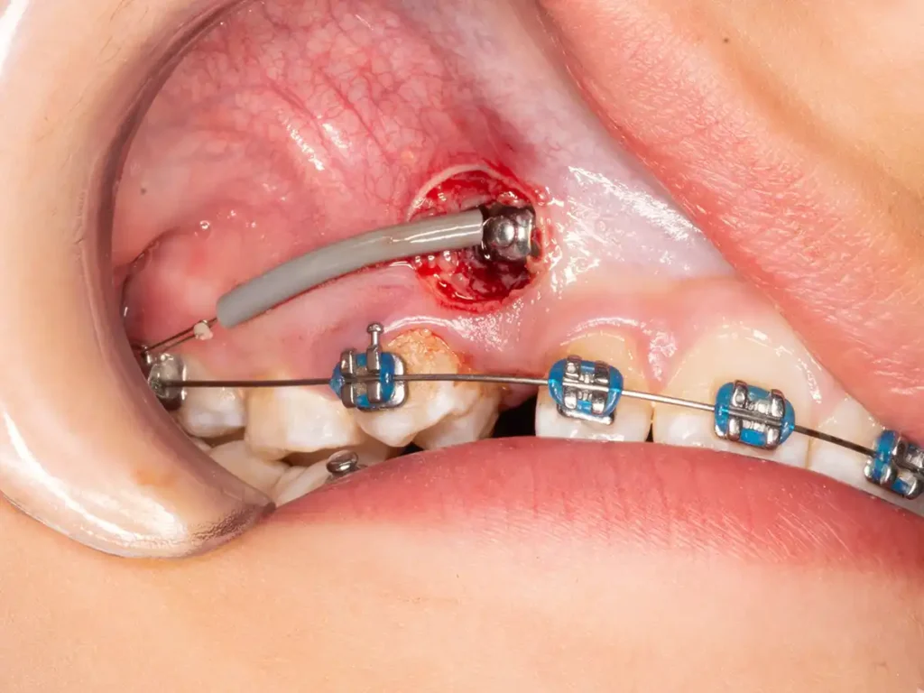 Canino retenido mecanoterapia ortodóntica inicial