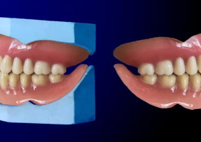 Prótesis dental toral superior e inferior