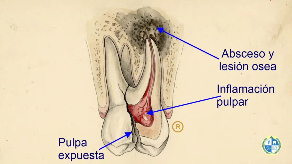 Pulpa inflamada, infección dentro del diente