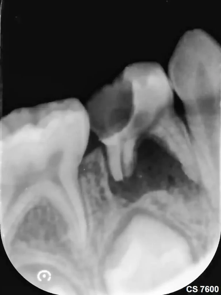 endodoncia ninos diente temporal radiografia puerto varas